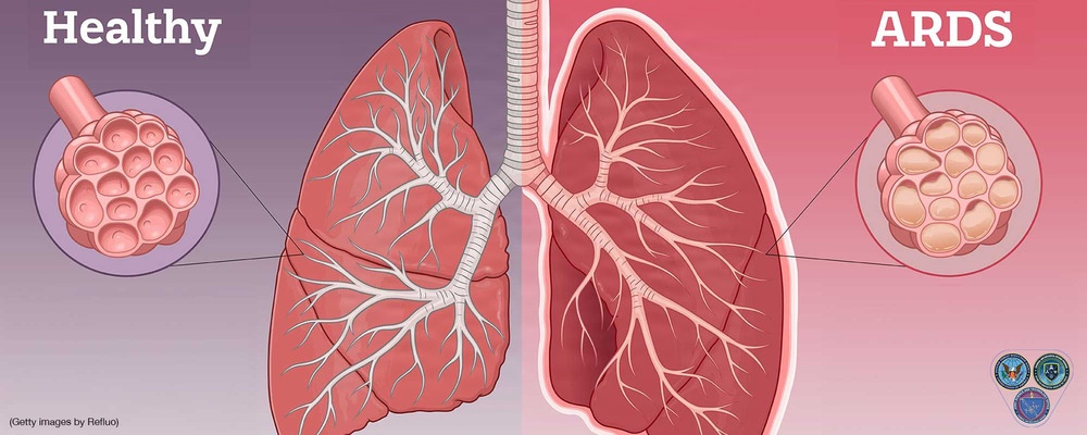 Infographic of JSTO in the News  Article  - Respiratory Reinforcements