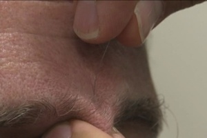 Battlefield Acupuncture, Part 2