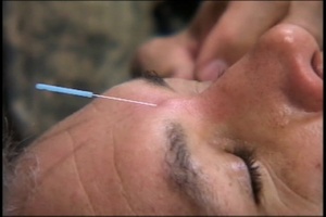 KAF Doctors Use Acupuncture to Treat TBI - Package, Short Version