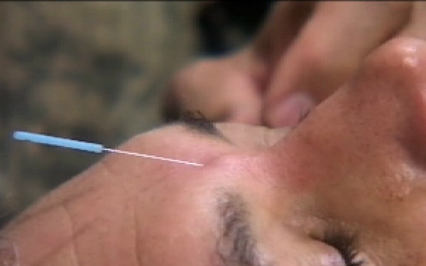 KAF Doctors Use Acupuncture to Treat TBI - Package, Short Version