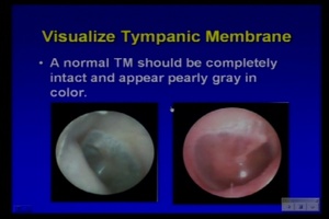 Otoscopy