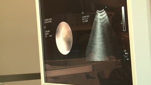Bronchoscopy
