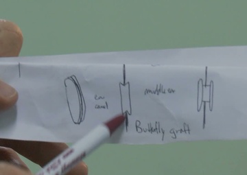 New Horizons Tympanoplasty Surgery