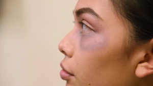 The Black Eye Campaign