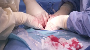 Hysterectomy Surgery Part 5 of 5 Slomo Broll - New Horizons