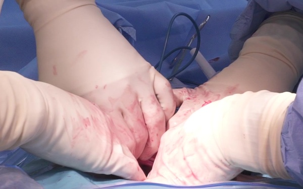 Hysterectomy Surgery Part 5 of 5 Slomo Broll - New Horizons