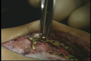 DISTAL RADIUS OSTEOTOMY FOR EXTRA-ARTICULAR MALUNION