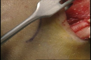 TECHNIQUES AND PITFALLS OF HAMSTRING HARVEST