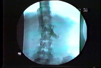 PELVIC VENOUS DISORDERS
