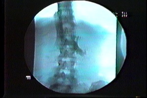 PELVIC VENOUS DISORDERS