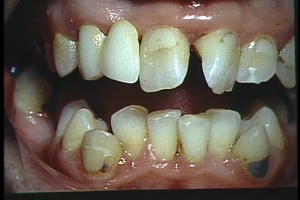 PRINCIPLES OF TOOTH SEPARATION IN THE CONSTRUCTION OF FULL AND PARTIAL CROWNS