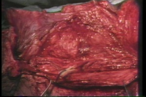 MAMMOTH INGUINAL HERNIORRHAPHY