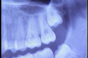 IMPACTED MOLARS