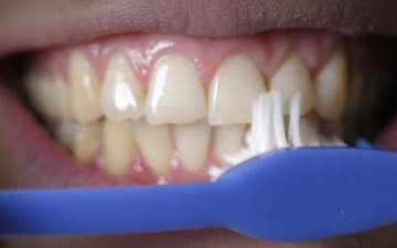 Dental Hygiene Awarness