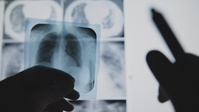 DHA Med News: Alzheimer's Disease and Lung Cancer