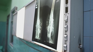 HEART 22 surgeons conduct osteosarcoma surgery in Honduras
