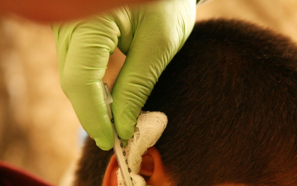 A medical professional wearing green latex gloves is performing a procedure on a person's ear, using a syringe or needle instrument along with gauze or cotton material. The procedure appears to be an ear-related medical treatment, possibly an injection, ear piercing, or wound care near the earlobe area. The patient appears to be a young person with dark short hair.