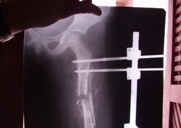 For Rusil: Troops Go the Distance to Care for Wounded Iraqi Girl