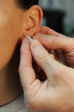 Administering Acupuncture