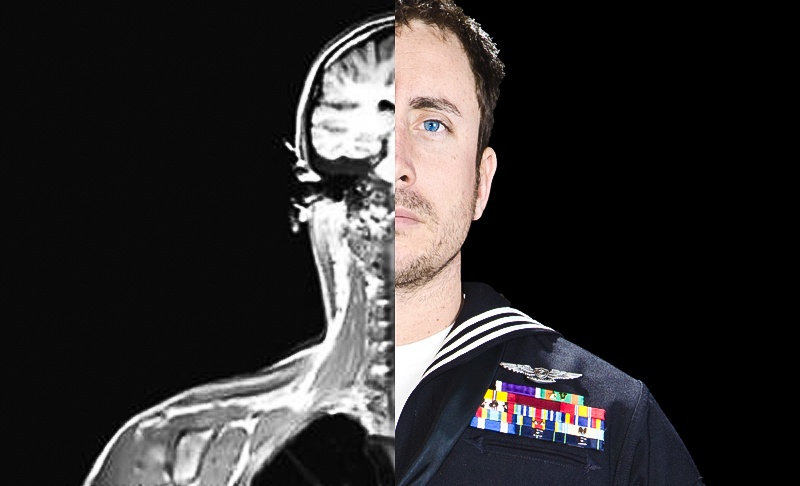 TBI, a hidden injury