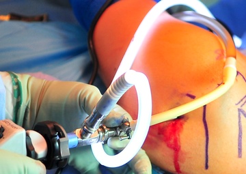 Torn Labrum Repaired