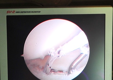 Torn Labrum Repaired