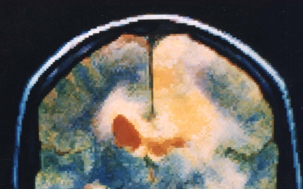 MRI Image of Human Head