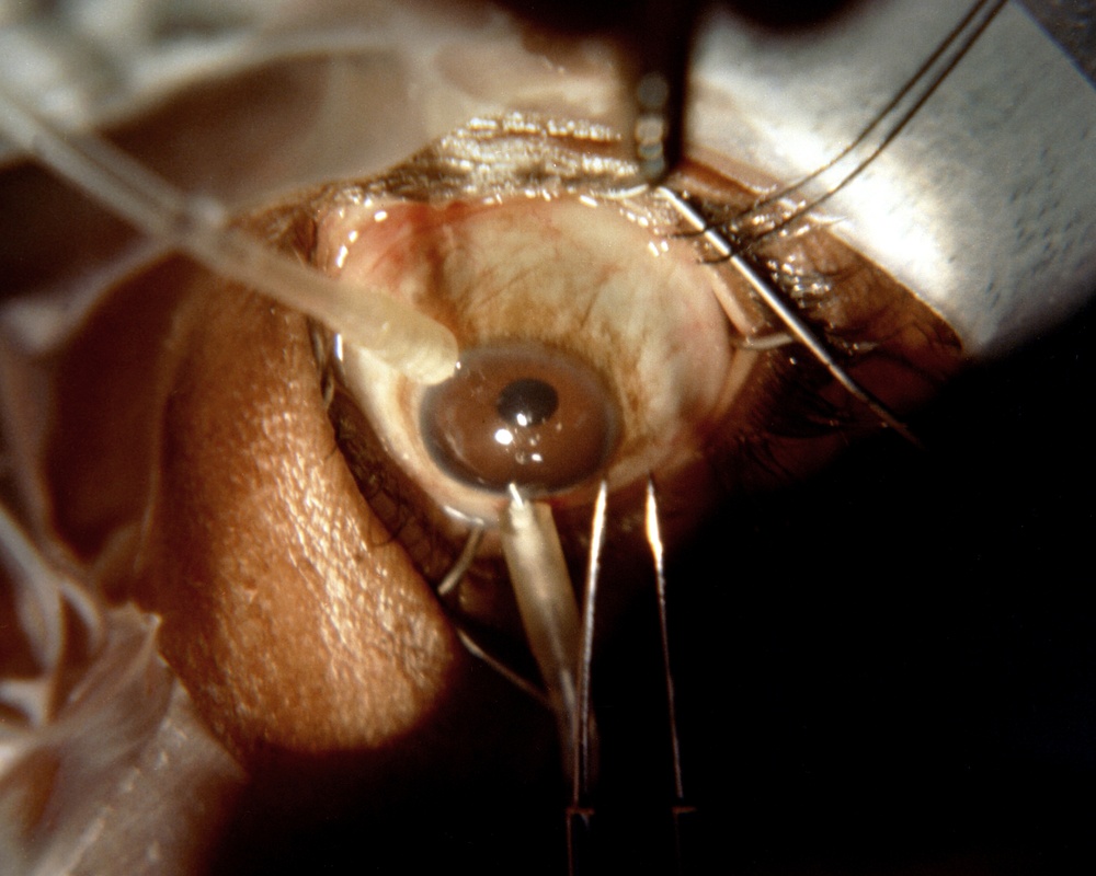 GLAUCOMA EYE SURGERY - KRESGE EYE INSTITUTE - DR DONG H SHIN - DETROIT MICHIGAN