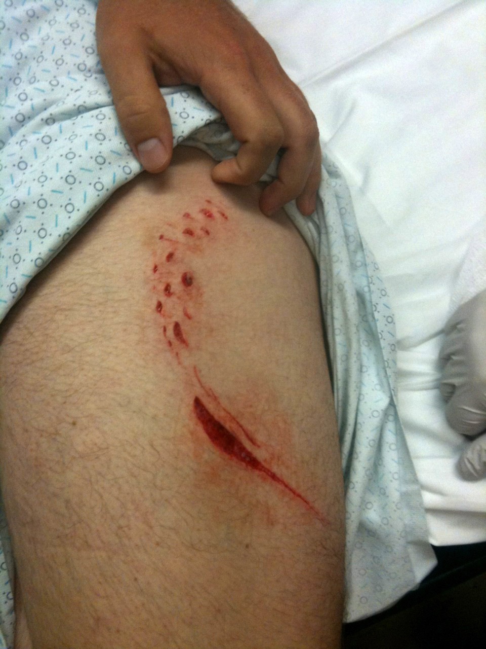 Shark bite feature photo