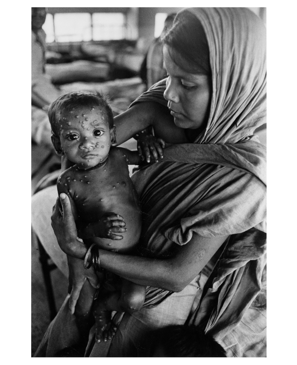 Smallpox in Dacca, Bangladesh
