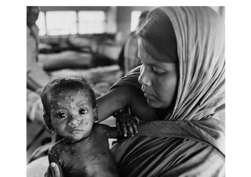 Smallpox in Dacca, Bangladesh
