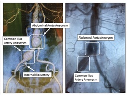 WBAMC, first DoD hospital to use new device for aneurysm