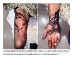 Where There’s Smoke, There’s Fire, especially with E-Cigarettes