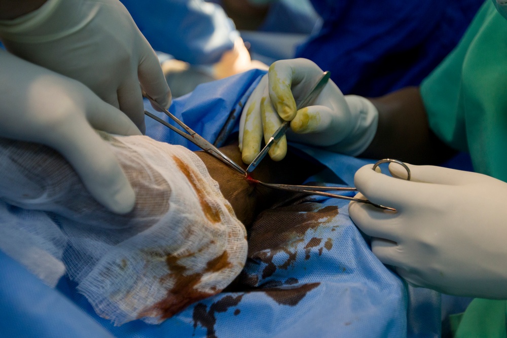 Surgeon Removes Lipoma