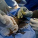 Surgeon Removes Lipoma