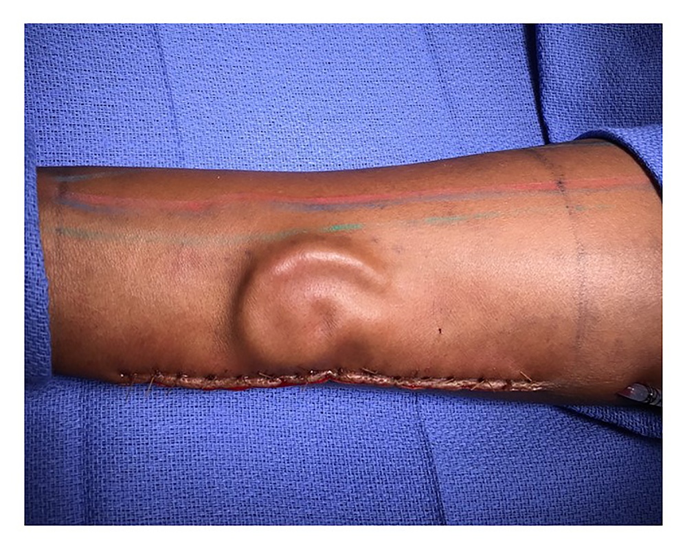 WBAMC doctor transplants ear “grown” on Soldier’s forearm