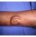 WBAMC doctor transplants ear “grown” on Soldier’s forearm