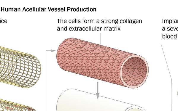 Surgeons Perform First Bioengineered Blood Vessel Transplant in Military Patient