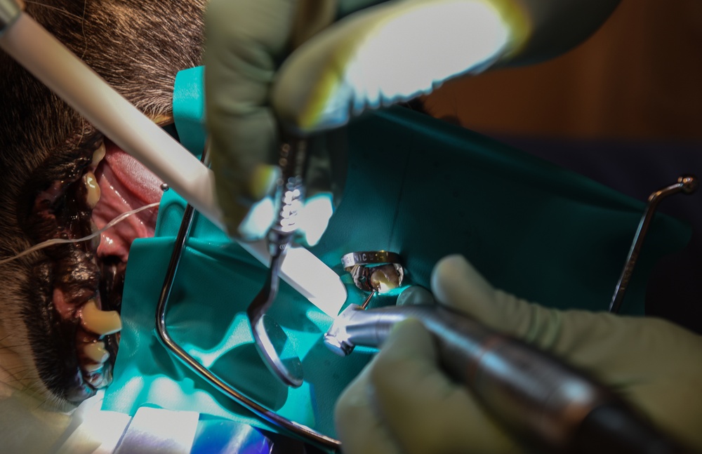 MWD root canal