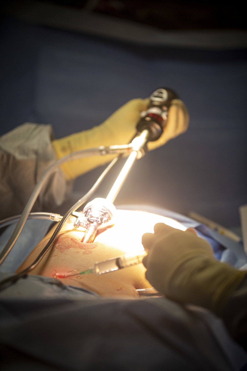 Surgical team conducts a laparoscopic appendectomy