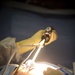 Surgical team conducts a laparoscopic appendectomy