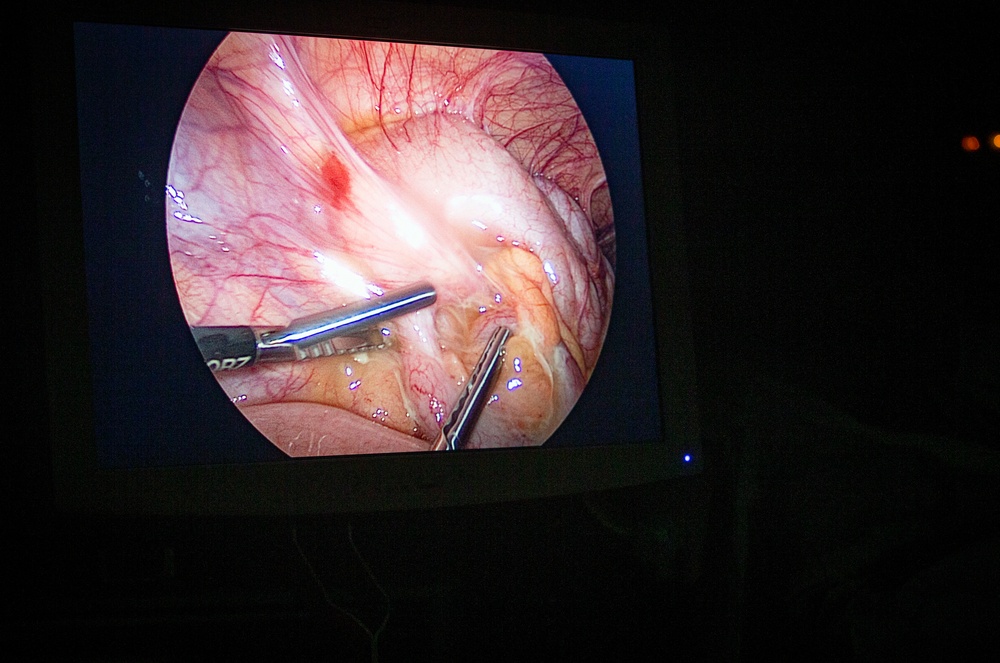 Surgical team conducts a laparoscopic appendectomy