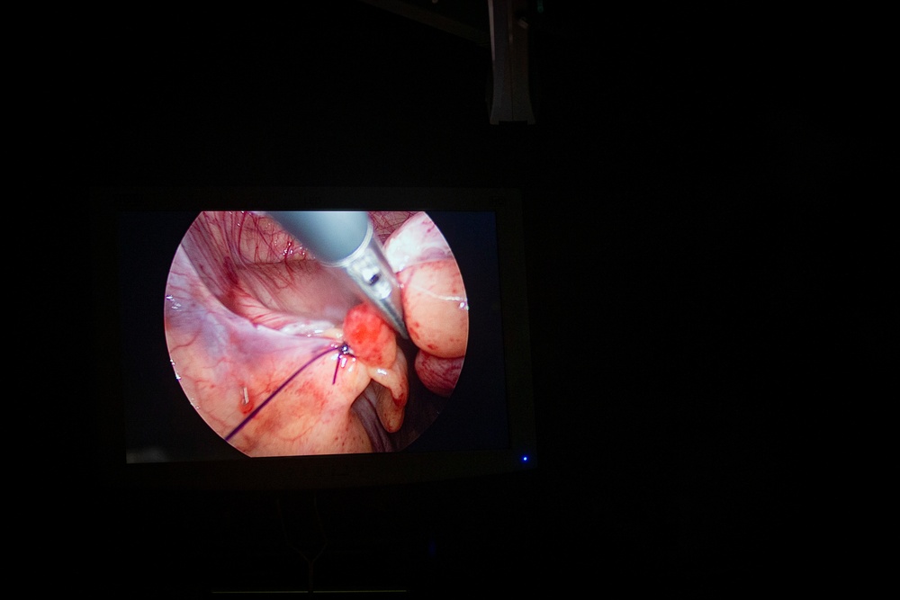 Surgical team conducts a laparoscopic appendectomy