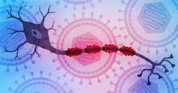 Study Identifies Epstein-Barr Virus Infection as a Leading Cause of Multiple Sclerosis