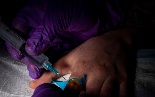 Gridley's medical conducts a wart removal procedure