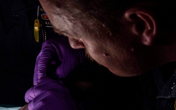 Gridley's medical conducts a wart removal procedure