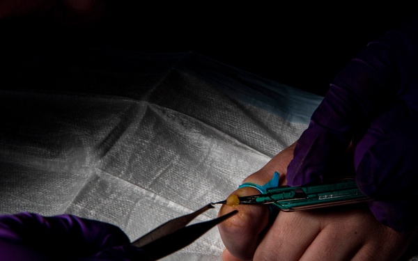 Gridley's medical conducts a wart removal procedure