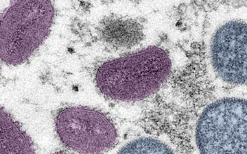 Mpox: CDC warns of potential new cases