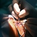 During HEART 22 U.S. and Guatemalan Ophthalmologist Save The Sight of a Young Guatemalan Child