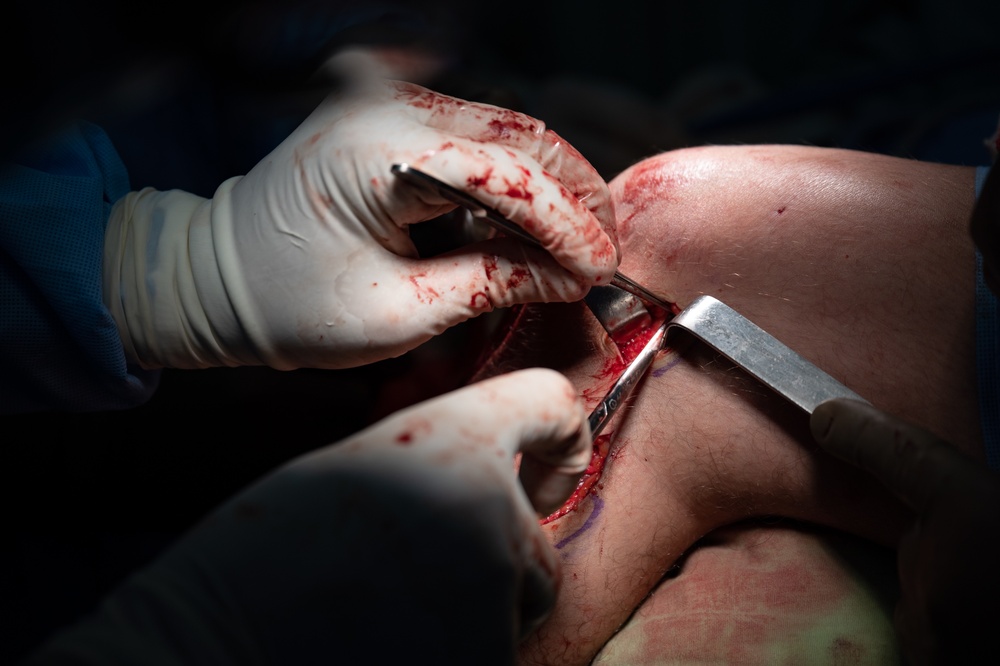 HEART 22 Orthopedic Team Conduct Life Changing Operations For Local Guatemalan Citizens
